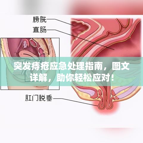 突发痔疮应急处理指南，图文详解，助你轻松应对！